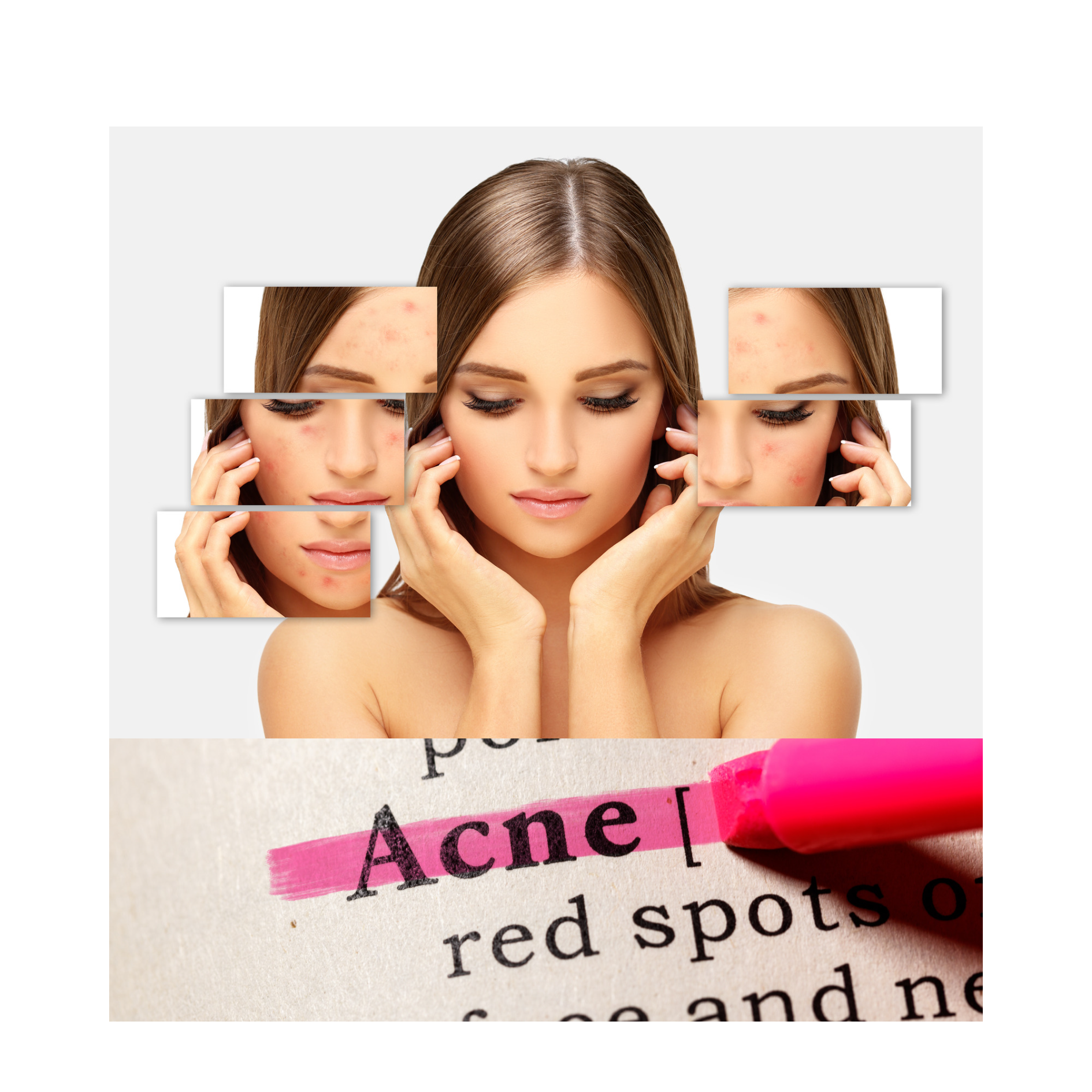 ACNE TIPS